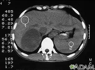 Cushing syndrome due to adrenal tumor